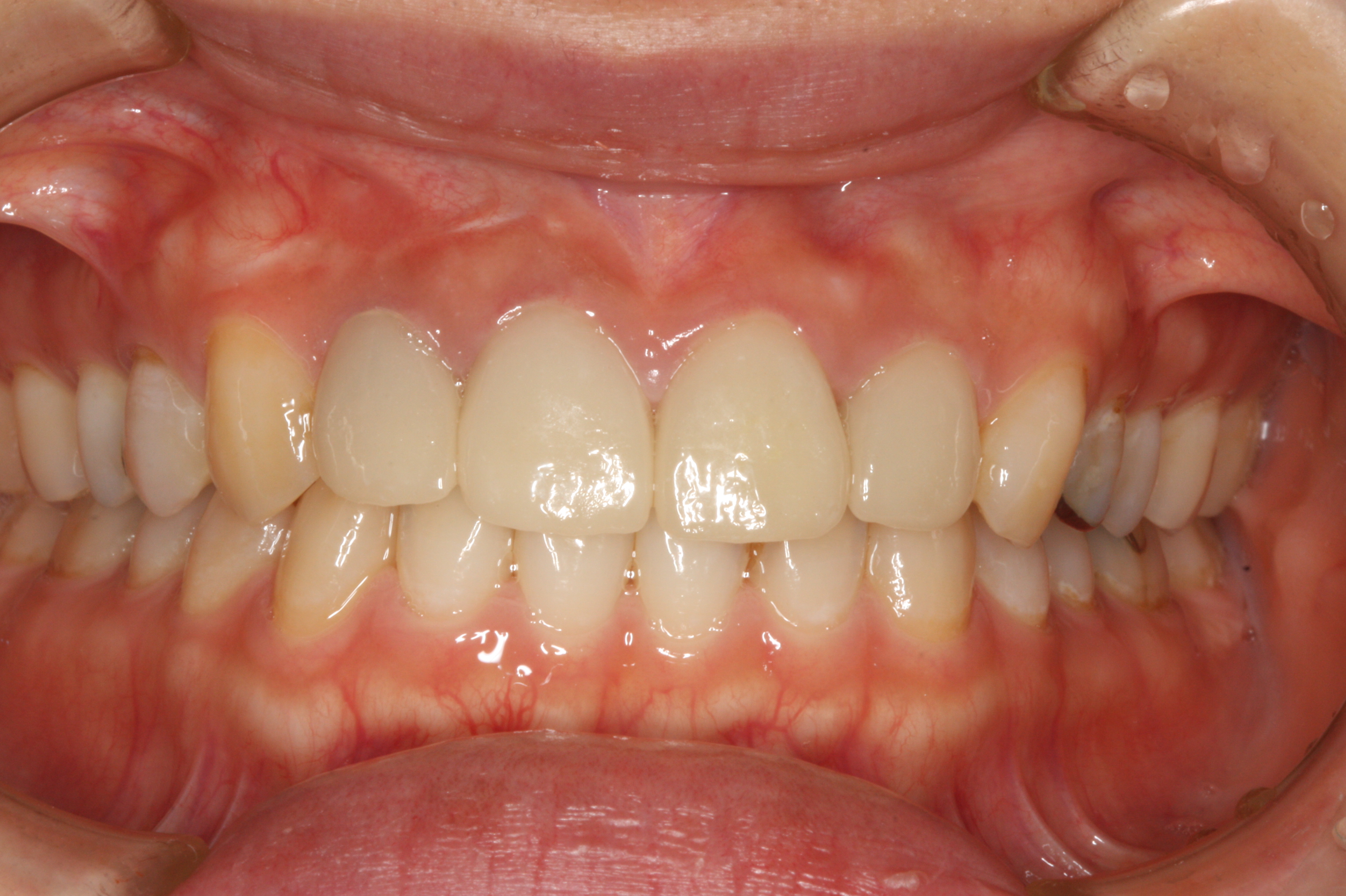 30代女性 前歯を安くきれいにしたい 宮崎歯科医院ブログ