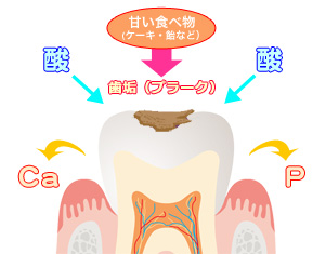 むし歯のメカニズム