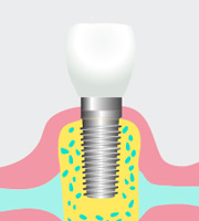 インプラント