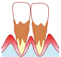 歯周病