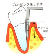 歯周病